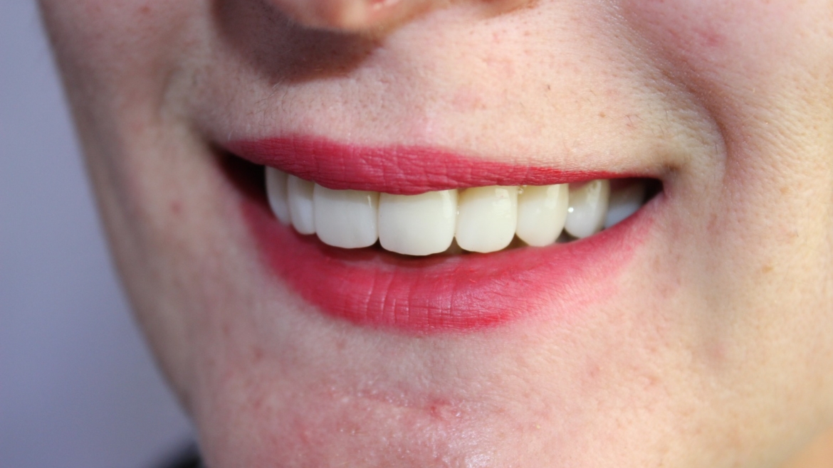 Allineare i denti: ortodonzia tradizionale o invisibile?