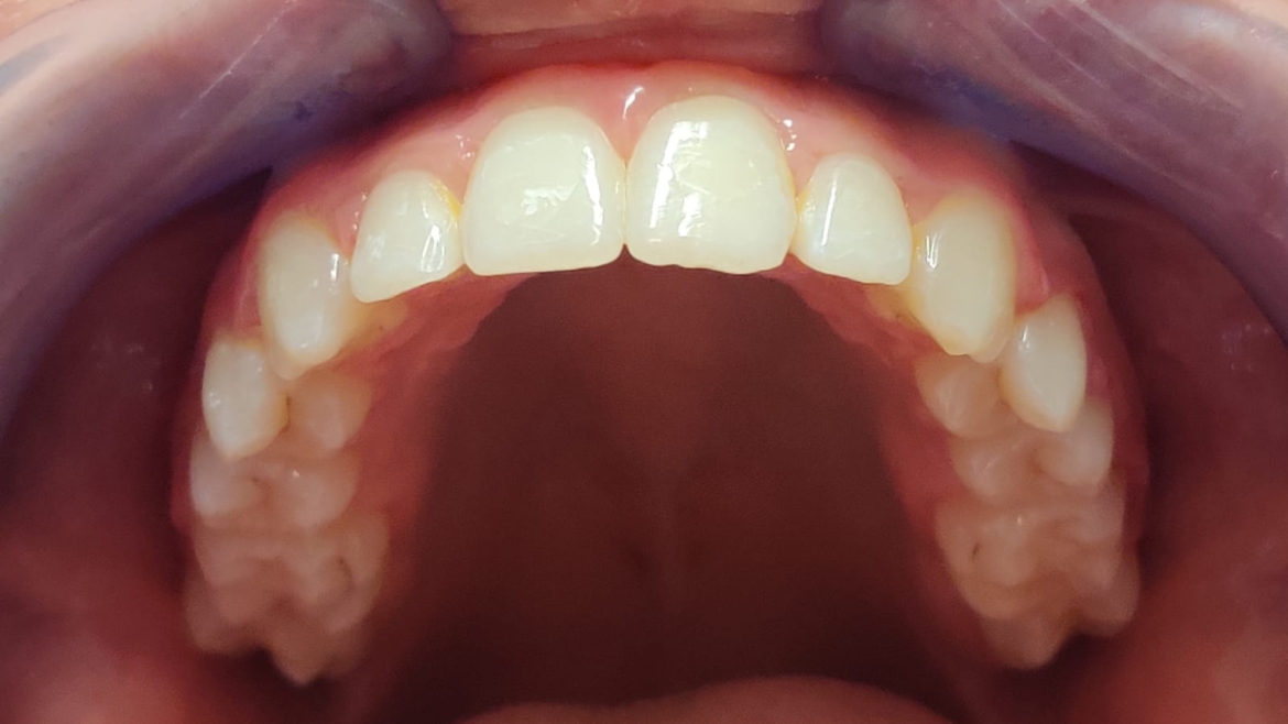 Malocclusione di II Classe – Terapia Ortodontica Fissa