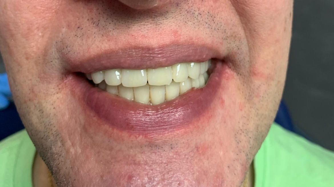 Riabilitazione completa con impianti e protesi fisse